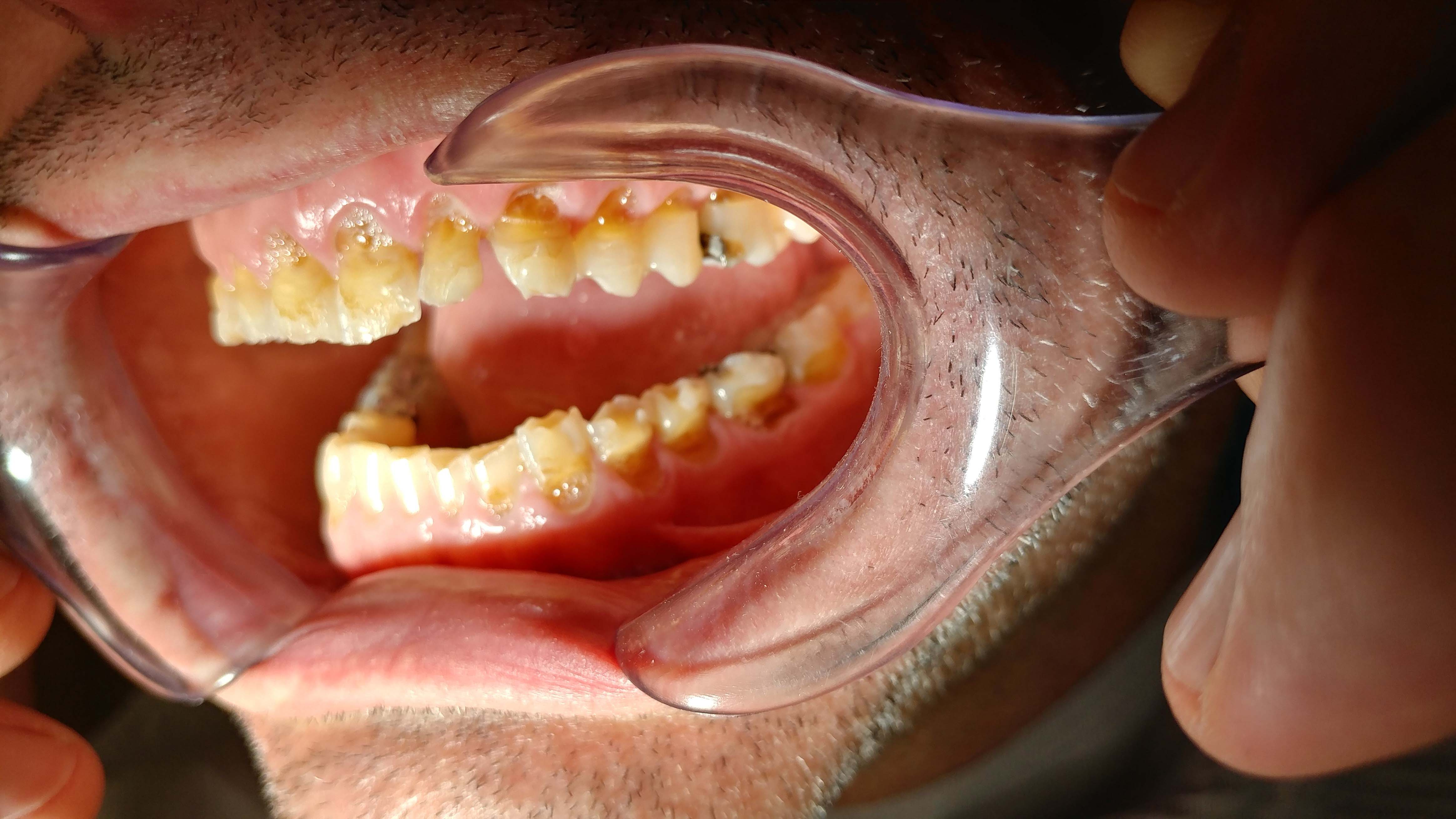 teeth lynn family dentistry